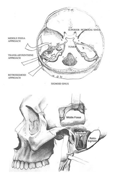 3 approaches to Acoustic Neuroma