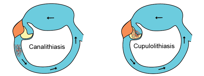 Canalithiasis