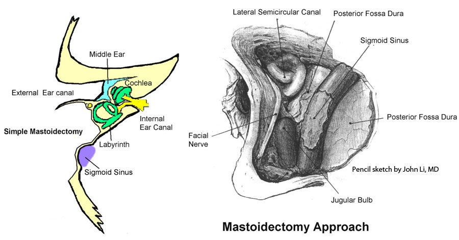 Mastoidectomy