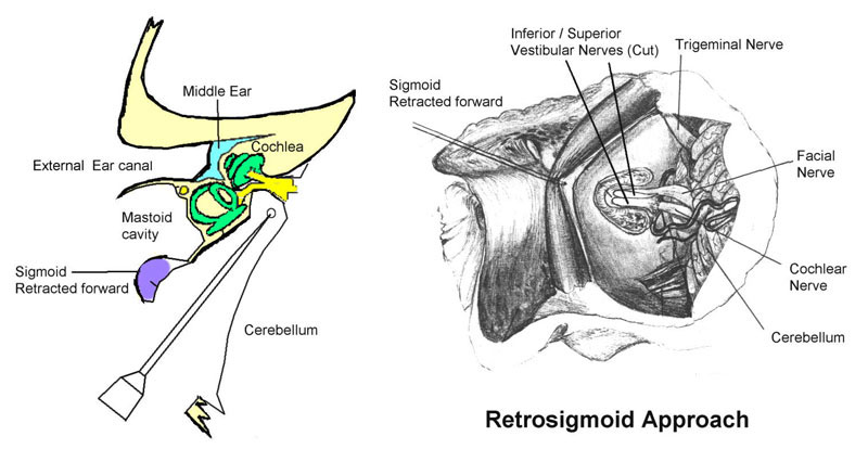 Retrosigmoid